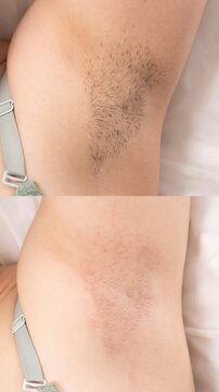 Collage of woman showing armpit before and after waxing depilation. Underarm Hair Removal procedures 