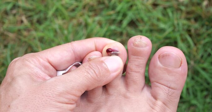 Cinematic close-up of a hand examining a bruised, broken toenail with subungual hematoma trauma, sports injury self-examination on grass background