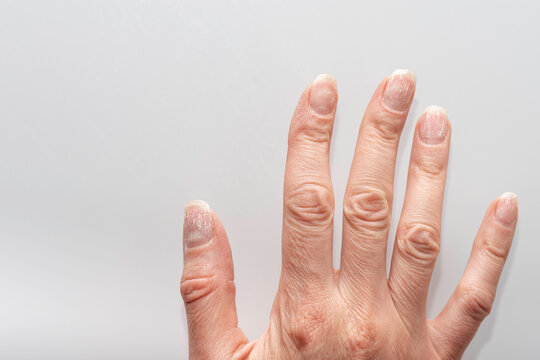 Damaged fingernails with white patches and dry cuticles on fingers close-up. A hand with problematic cuticles and broken nails. Emotional stress. Age-related skin changes. Hand care.