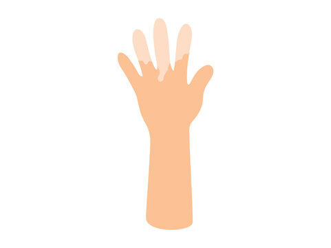Raynaud Syndrome or Raynauds Phenomenon
