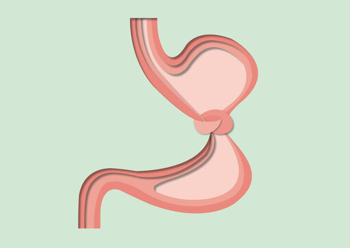 Knotted stomach, conceptual illustration