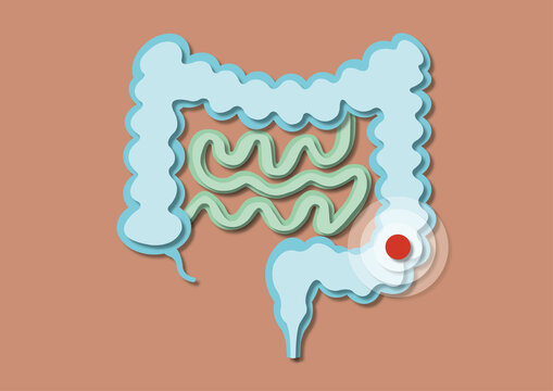 Chrohn's disease, conceptual illustration