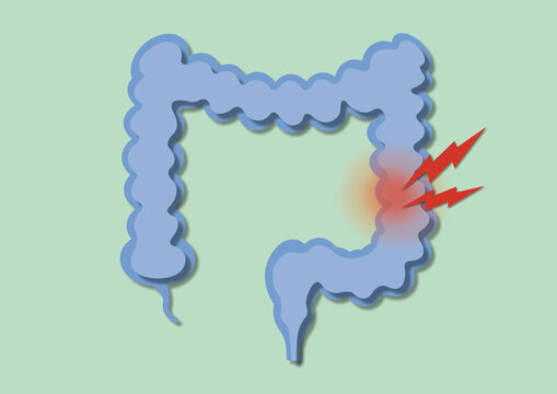 Colon pain, conceptual illustration