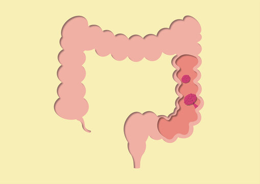 Colon polyps, conceptual illustration