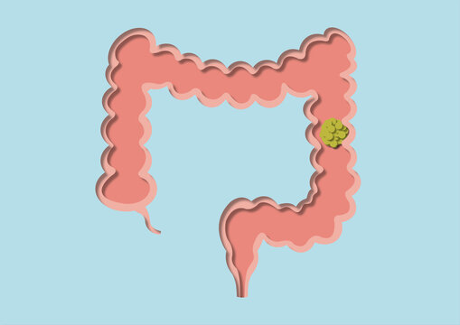 Colon cancer, conceptual illustration