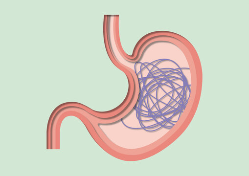 Knotted stomach, conceptual illustration