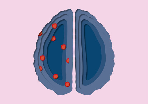 Neurodegenerative disease, conceptual illustration