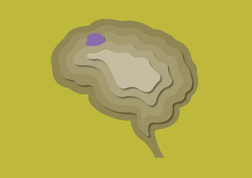 Brain tumour, conceptual illustration
