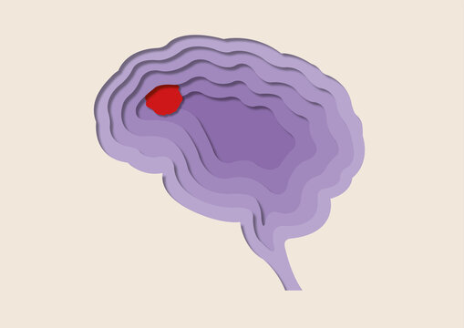 Brain tumour, conceptual illustration