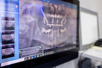 Dental panoramic radiograph displayed on a clinic monitor, close view of jaw imaging software with blurred workstation background for implant planning oral diagnostics © Artem