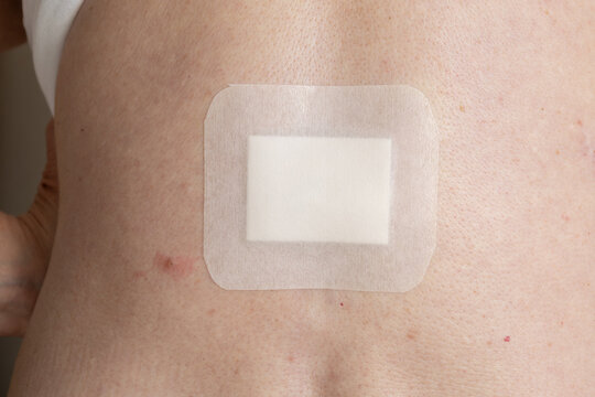 postoperative bandage after skin lesion removal on back