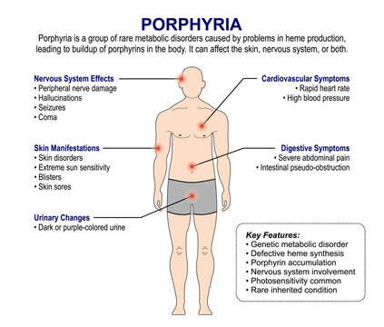 Porphyria, Acute and Cutaneous Porphyrias Flashcard Illustration