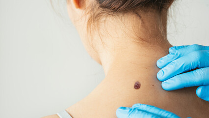 Plakat Examining skin for potential cancerous growths