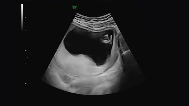 2D Medical Ultrasound Scan of Fetus in Womb During Pregnancy