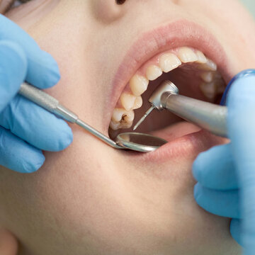 Extreme macro close-up of a child's mouth during dental treatment for a cavity on deciduous molars. 