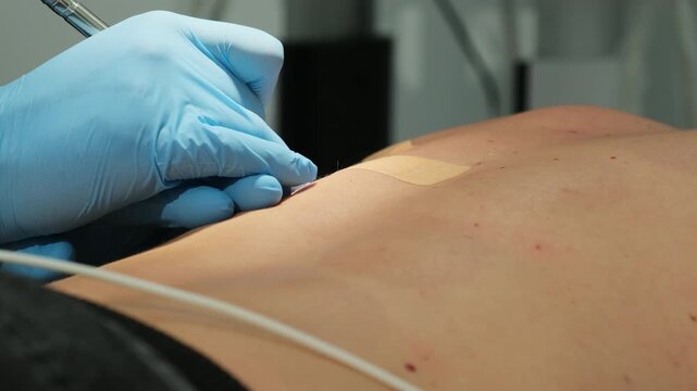 Dermatologist uses laser coagulation to cut out patient mole in clinic slow motion. Doctor conducts skin surgery with modern tools closeup