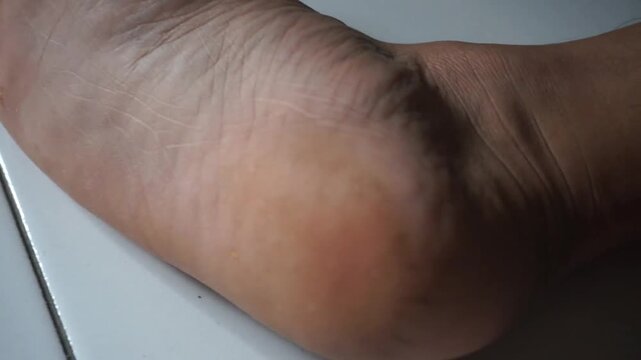 Close-up of bare feet with dry, cracked skin on the heels on a white background. Medical details of the skin condition. Concept of foot care, dryness, and skin care.
