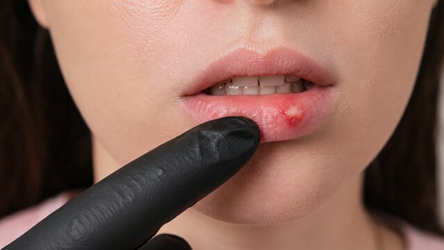 High-resolution 4K image showing a medical professional in a black glove pointing to a painful, red ulcerous blister lesion on a woman's lower lip.