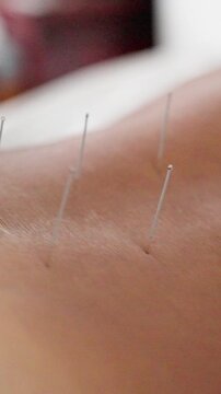 Needles Positioned During Gentle Retention Phase. Scene Showing Needles Nestled On Skin During Therapy Process. Close Examination Of Acupuncture Needles Retained On Skin After Treatment Concludes