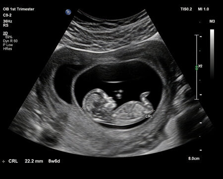 Early pregnancy ultrasound scan showing fetus at 8 weeks 6 days