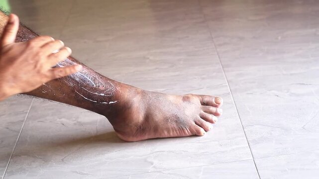 Man with dry skin applying cream onto his foot on bed, closeup