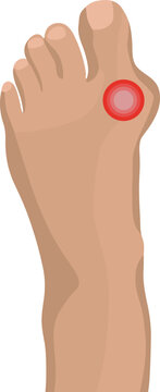 Vector isolated illustration of bunion disease.