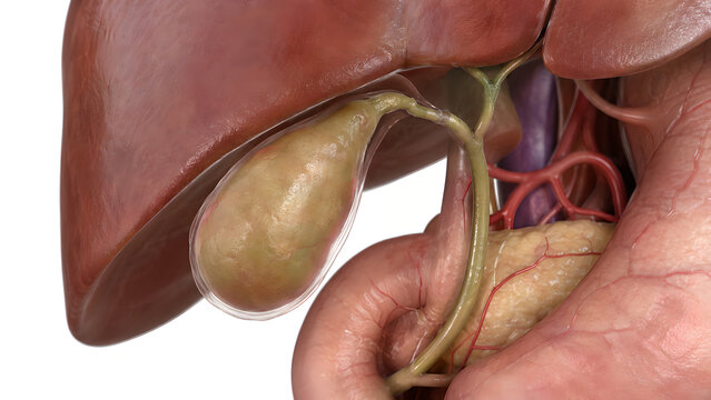 Acute Cholecystitis Gallbladder Anatomy 3D Medical Illustration for Digestive Health Education and Patient Brochure