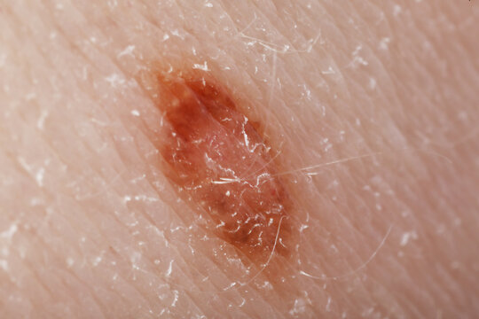 Macro view of skin with birthmark as background
