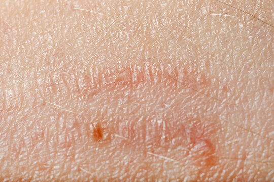 Macro view of skin with birthmarks as background