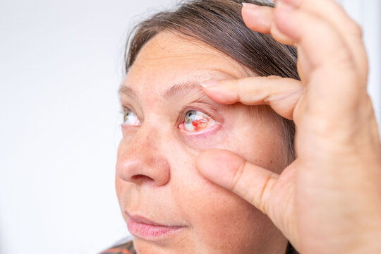 Close-up human eye with severe redness and broken blood vessels, showing subconjunctival hemorrhage, clinical detail for medical, health, and ophthalmology concepts, patient healing, blood vessel
