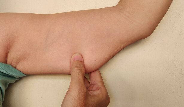 woman holding the flabbiness adipose sagging skin, wrinkle and Flabby skin under the arm, armpit and loose on the body of the woman, health care and beauty concept.	
