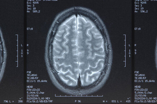 Brain MRI scan from above in studio showing detailed anatomy