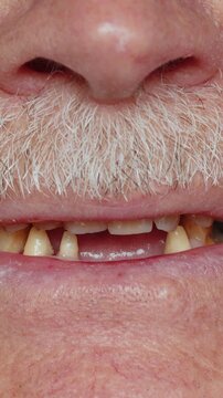 Close-up macro shot of toothless male smile mouth of senior mature man. Dental problem, bad teeth loss. Pensioner grandfather guy showing rotten teeth, caries, decayed, weak enamel, teeth falling out.