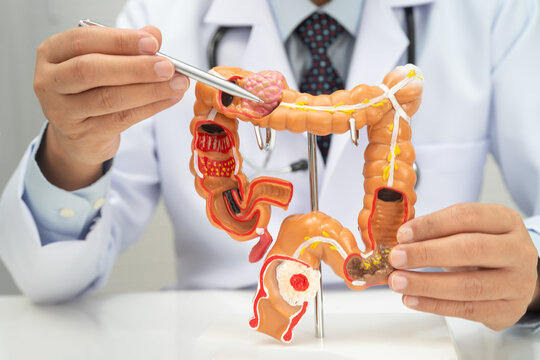 Colorectal cancer, doctor holding intestine colon human model.
