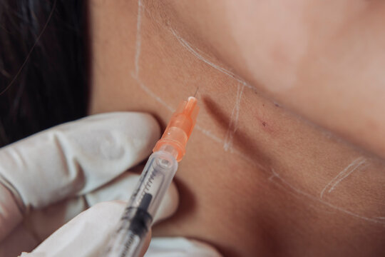 Female patient receiving mesotherapy injections at an aesthetic clinic below the jawline for double chin reduction and contouring