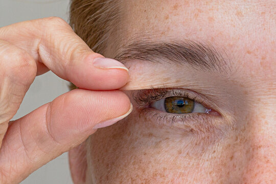 Hand pulling the upper eyelid to show the hooded eyelid concept cropped