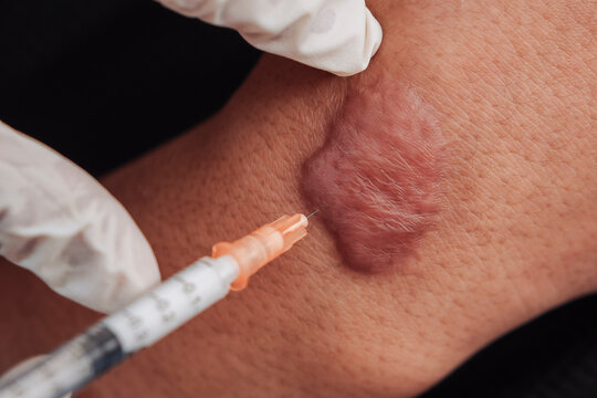 Patient receiving intralesional corticosteroid injection on a hand at an aesthetic clinic for keloid scar reduction and hypertrophic scar treatment
