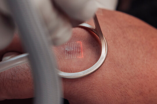 Closeup of fractional carbon dioxide laser treatment at an aesthetic clinic for keloid reduction and scar remodeling
