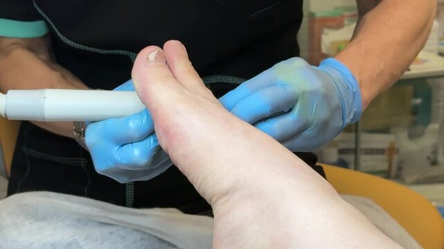 Onychomycosis. The process of treating toenails by a doctor. A dangerous fungal infection of toenails in a person sitting in an examination chair. Disease and detachment of the nail plate