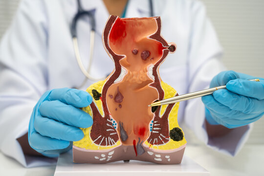 Asian doctor with rectum and hemorrhoid human model, inflamed vascular structure.