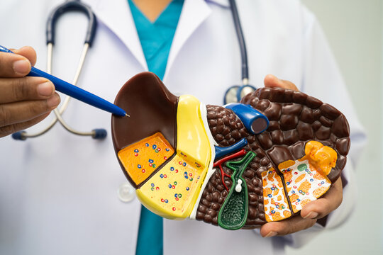 Cirrhosis, Liver cancer, fatty liver, Asian doctor with liver human model.