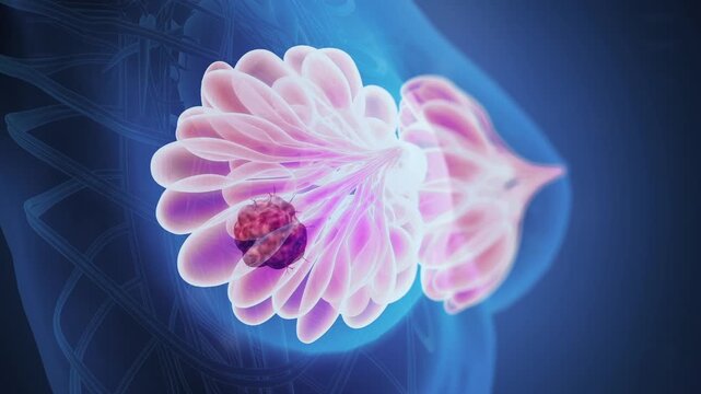 3D Animation Breast Tumor & Breast Cancer Progression, Uncontrolled Cancer Cell Growth in Breast Tissue