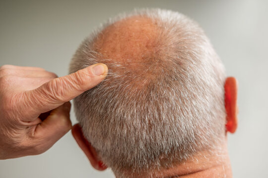 Close up senior man 60-65 years old, man's head showing round bald spot on crown, vertex baldness, short hair on sides, scalp texture, male pattern baldness concept, targeting follicle strength