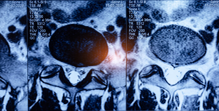 Lumbar spine mri showing disc herniation in radiology