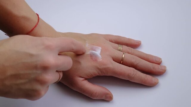 Burn on a woman hand. Selective focus. people.