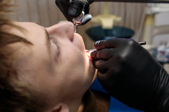 extreme close up of dentist in black gloves administering injection near child patient mouth with syringe during dental anesthesia procedure