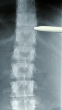 Doctor radiologically analyzing the spinal column with x-ray.
Hand of a doctor analyzing and pointing with a pen to the affected area.