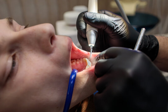 extreme close up of dental scaler tip working inside wide open mouth showing lower teeth gum and blue suction tube with black gloved hands