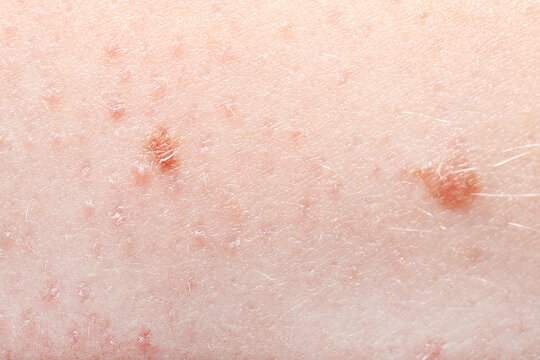 Macro view of skin with birthmarks as background