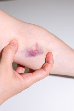 bruise on female hand skin, hematoma on elbow area from blood draw, hurt mark, medical treatment, symptom medical condition, body pain, Health care